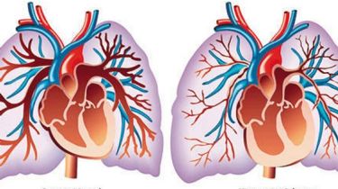 Hipertensión pulmonar: Una de las enfermedades más raras del mundo