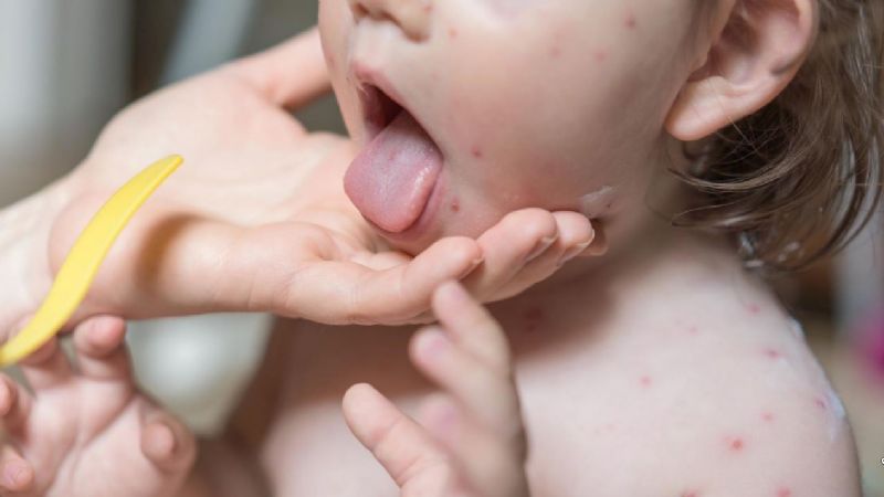 Qué es el contagioso síndrome mano-boca-pie y cómo afecta a los niños y adultos