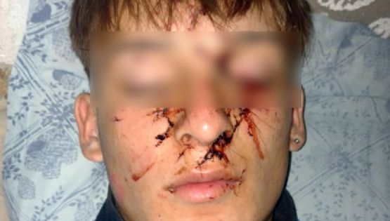 Brutal agresión a un adolescente necochense en un boliche de Claromecó